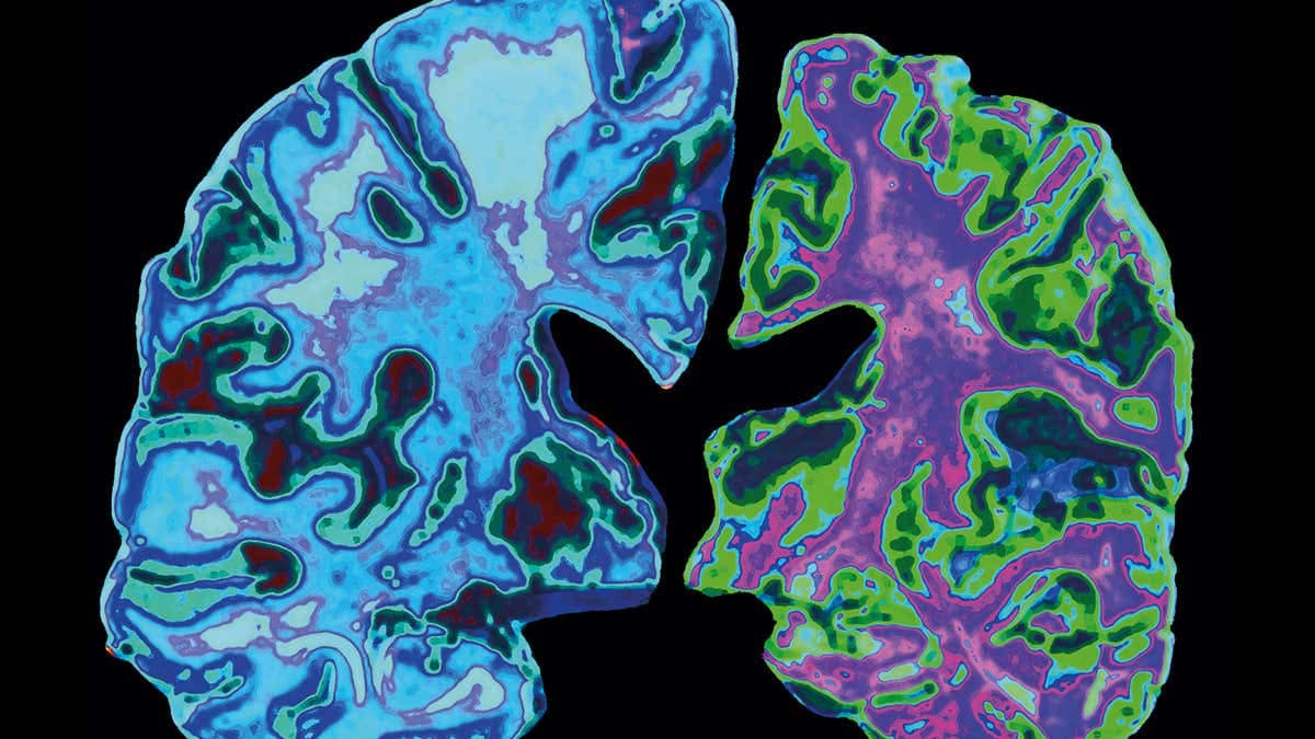 Alzheimer Hastalığının Bu Sebebini Çoğu Kişi Bilmiyor