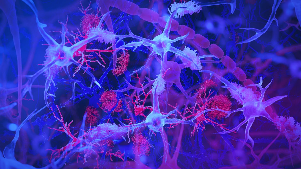 Alzheimer Hastalığının Bu Sebebini Çoğu Kişi Bilmiyor